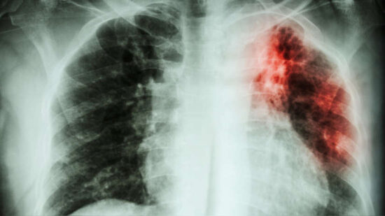 cómo es el tratamiento de la tuberculosis