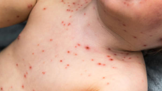6 enfermedades de la piel